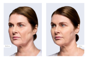 Clinical Outcomes Laura