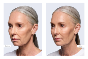 Clinical Outcomes Mandy