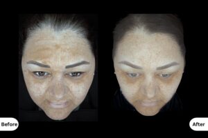 Clinical Outcomes Treating Ageing and Poor Texture