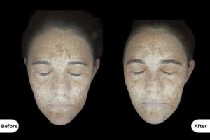 Clinical Outcomes Treating Pigmentation and Ageing