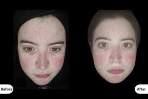 Clinical Outcomes Treating Sensitivity and Poor Texture